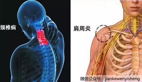 脖子酸痛=颈椎病or肩周炎？别傻了，这种病痛可能是大病之兆！