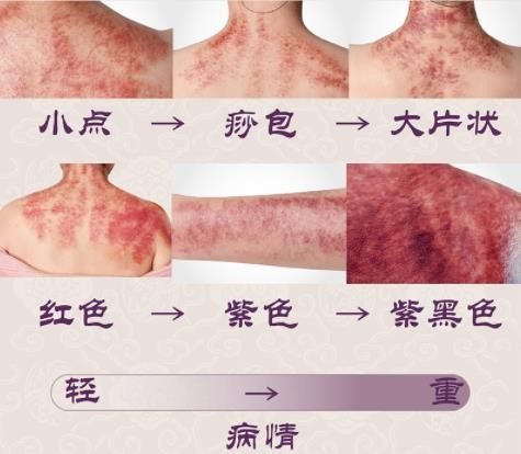 刮痧出痧图与病症对照(刮痧出痧图与病症对照图片)