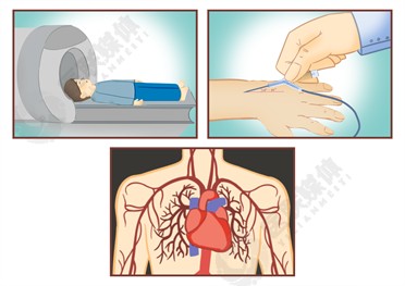 肺灌注显像