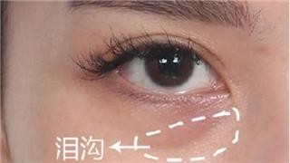 玻尿酸丰泪沟：医美新宠