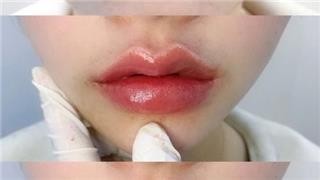 玻尿酸丰唇：医美新宠的科学与魅力！