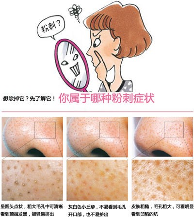 OL常受粉刺烦恼