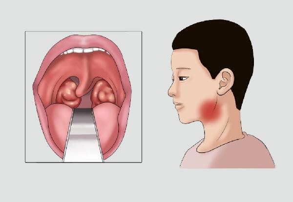 扁桃体发炎的症状