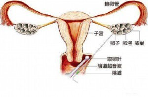 新加坡三代试管婴儿的费用明细及省钱小贴士，来看价钱明细！