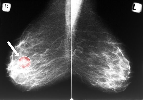 乳腺癌切除术后乳腺癌义乳佩戴相关问题