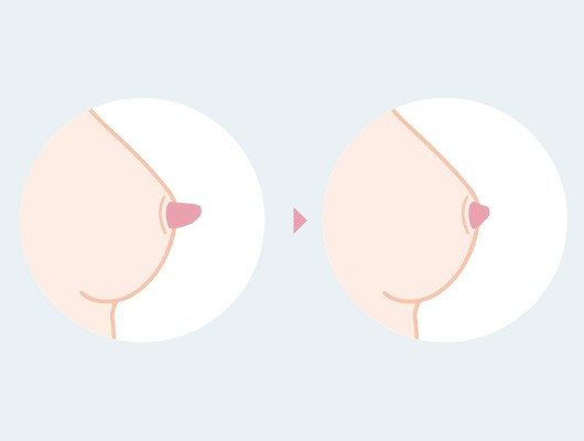 乳頭縮小