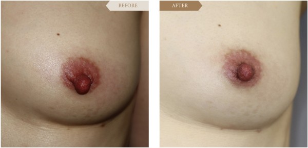 左側　乳頭（乳首）縮小