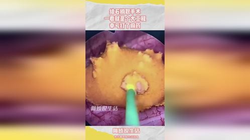 结石摘取手术，一看就是个大工程，幸亏打了麻药！