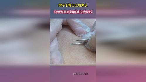 男子手臂上出现黑点，没想到黑点却能被拉成长线