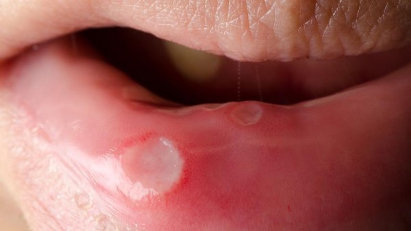 避免口腔溃疡怎么护理口腔?口腔溃疡久治不愈怎么办好?