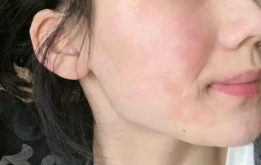 换季身上起红疙瘩很痒怎么办 换季皮肤过敏怎么解决