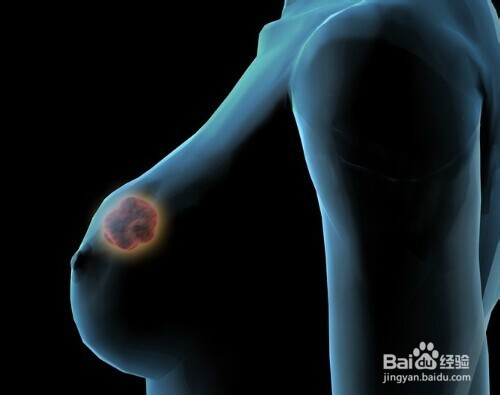 哺乳期乳房有硬块怎么办