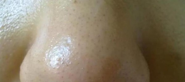 螨虫存在于皮肤和室内很多阴暗的角落，几个方法就除螨！