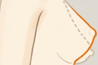 乳房下垂悬吊价格多少贵吗？约2万起