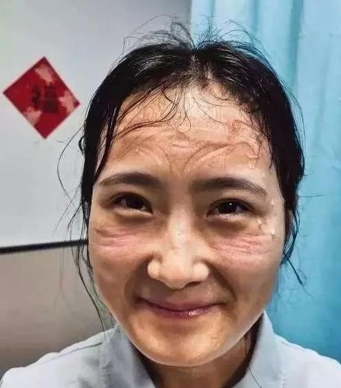 揭开玻尿酸抗皱密码，肌肤冻龄不是梦