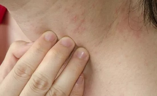 李时珍养生堂：皮肤过敏怎么办？6个妙招教你防治