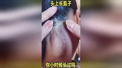 头上长虱子，你小时候长过吗