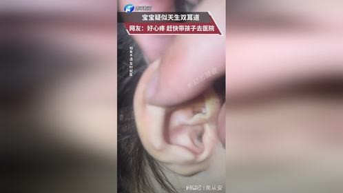 宝宝疑似天生双耳 网友好心疼 赶快带孩子去医院