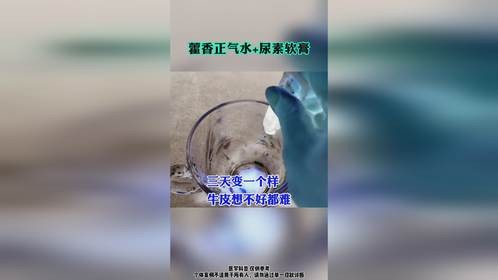 藿香正气水+尿素软膏帮助牛皮癣恢复