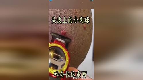 头皮上的小肉球，咋会长这东西！