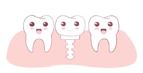 种植牙动画图