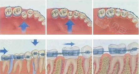 牙齿矫正移动过程示意图