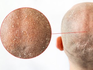 脱发严重日常生活怎么办