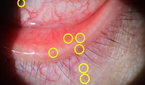 剧痛！一阵风吹过，女子眼睛被扎进7根“黑刺”……近期多人中招