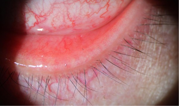 剧痛！一阵风吹过，女子眼睛被扎进7根“黑刺”……近期多人中招