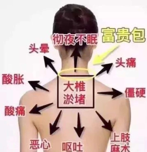 富贵包”=“夺命包”？教你3招轻松调理，效果很明显哦