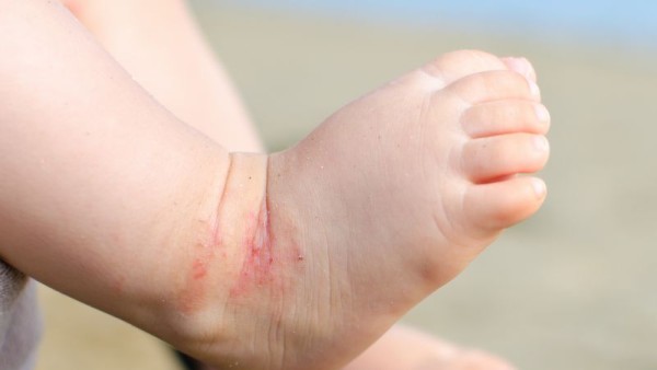 宝宝湿疹的解决方法