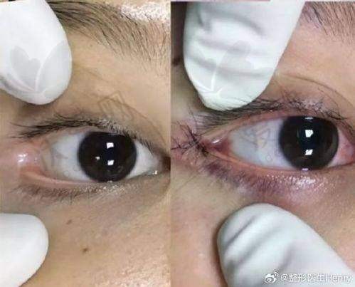 武汉仁爱时光医疗美容医院开外眼角价格为何如此实惠？