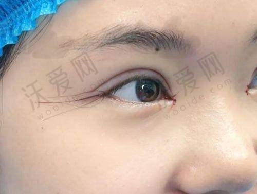 武汉仁爱时光医疗美容医院开外眼角术后护理需要注意什么？