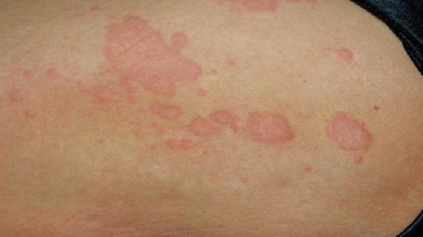 湿疹日常该怎么护理呢