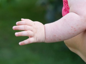 过敏了能睡觉吗