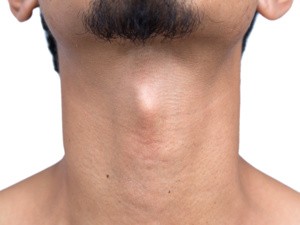 热点重点：北京华坛中西医结合医院超微冷循环技术很不错“排名全面公开”北京华坛甲状腺科裴海旭主任提醒：甲亢突眼患者，夏天一定要做好防晒