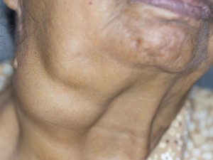 排行更新：北京华坛中西医结合医院专业治疗甲亢、甲减、甲状腺结节、甲状腺炎“热点推荐”北京华坛甲状腺科裴海旭主任提醒：上班族保护甲状腺，记住这 3 个小技巧