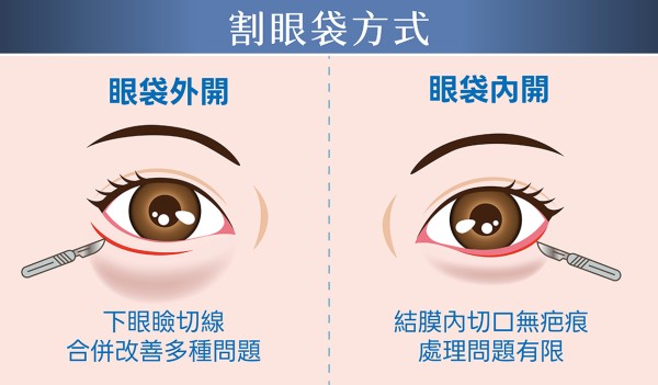 割眼袋方式