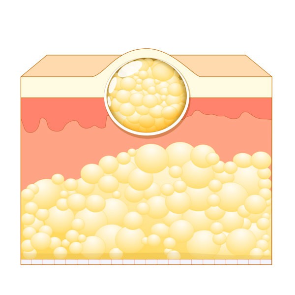 脂肪胶填充在山根部位会移位吗