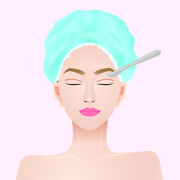 上睑下垂后多久正常生活