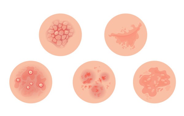 哮喘病应该注意什么