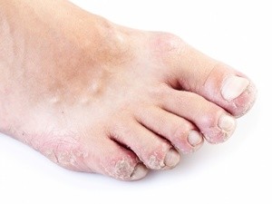 浴室脚气怎么消毒